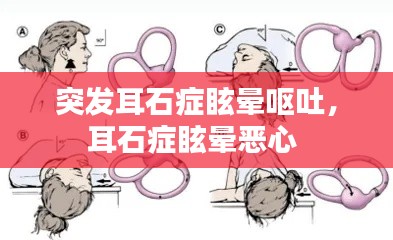 突发耳石症眩晕呕吐,耳石症眩晕恶心